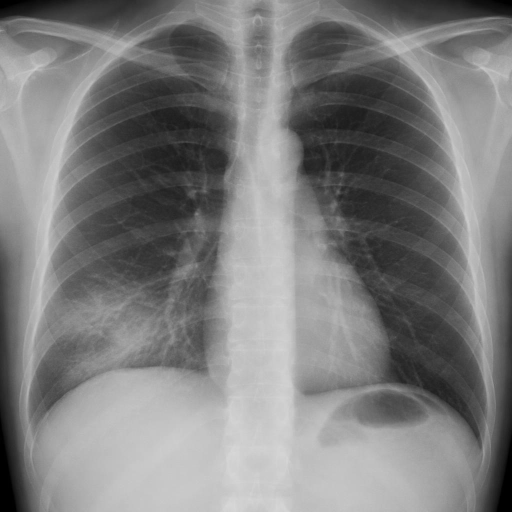 Sample chest X-ray with a marked finding